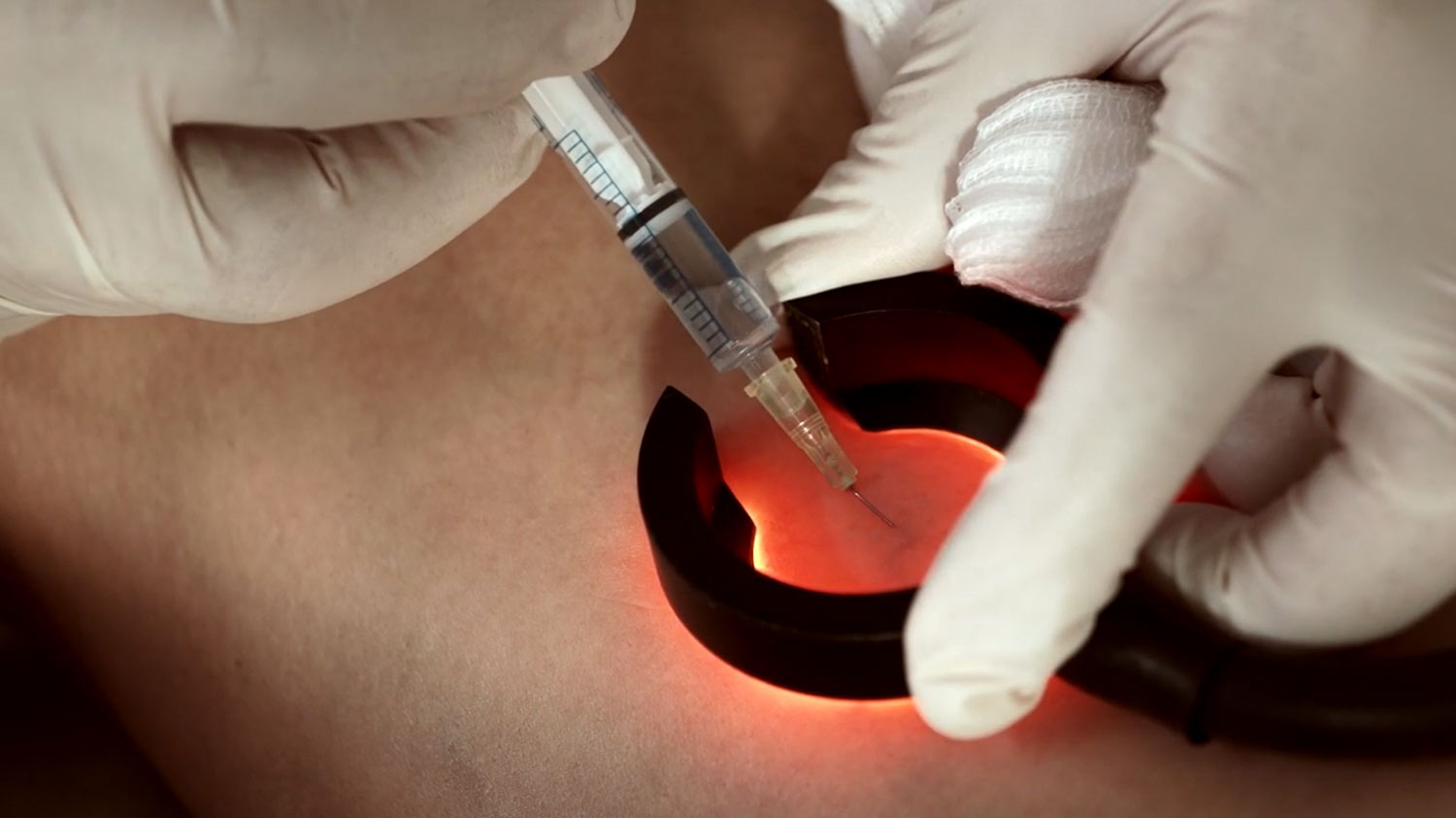 Endovenöse Verfahren zur Behandlung von Venenleiden