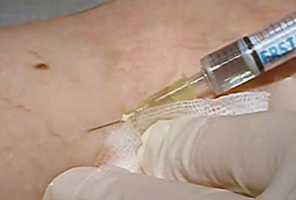 sklerotherapie-venenleiden-behandeln Sklerotherapie | Venenleiden vehandeln